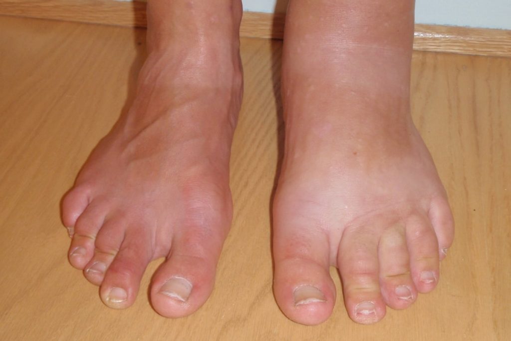 bilateral edema