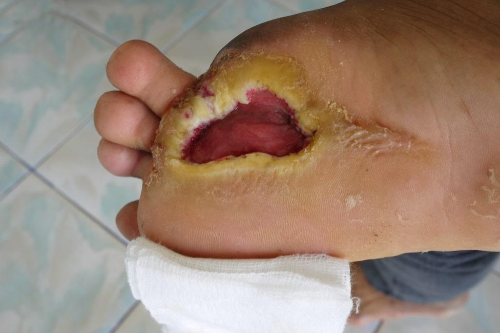 diabetic foot ulcer