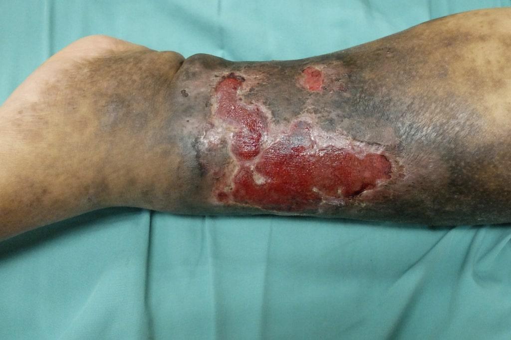 venous ulcers